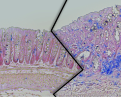 Dickdarmgewebe aus schlanken (links) und übergewichtigen (rechts) Mäusen der Darmkrebsstudie. Bei den übergewichtigen Tieren ist ein verstärktes Tumorwachstum mit erhöhter Immunzellanzahl (blau) zu sehen. (Bildmontage)
